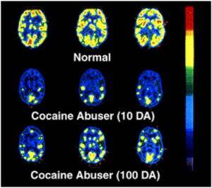 Addiction as a brain disease