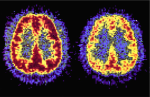 Addiction as a brain disease